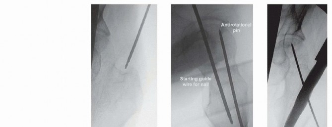 Illustration 21 for Is a Sliding Hip Screw Best for Your Femoral Neck Fracture?