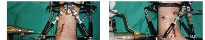 Illustration 46 for Optimize Pain Management with Proximal Ring Block for Ankle Arthrodesis