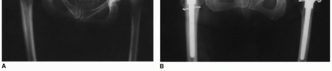 Illustration 2 for Recreate Hip Biomechanics: Modular Stems for Modular Solutions