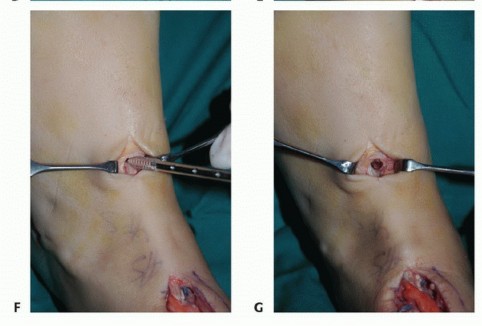 Illustration 54 for Foot Drop Surgery: How a Pin or Drill Elevates Tendon Transfer