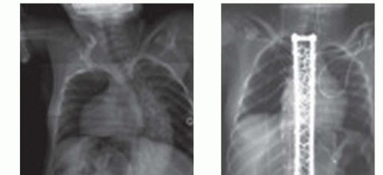 Illustration 30 for Duchenne Muscular Dystrophy: Is Spinal Fusion the Answer?