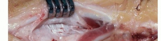 Illustration 12 for Precision Correction for Distal Radius Malunion