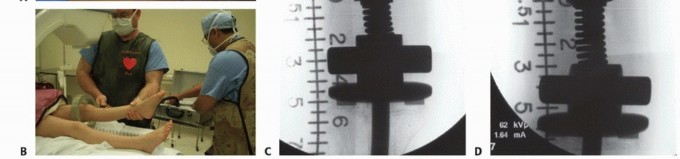Illustration 30 for Distal Femoral Replacement: Key to Modern Limb Salvage
