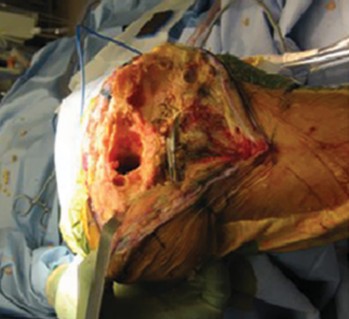 Uncemented Stems in Revision: A Guide to Success & Pitfalls