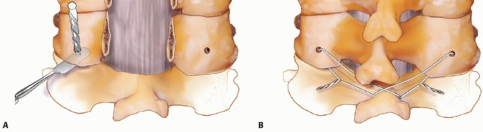 Illustration 15 for Achieve Stability: Posterior Cervical Lateral Mass Screw Fusion