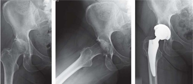 Illustration 66 for Unlock better THA: The technique of short stem for less invasiveness