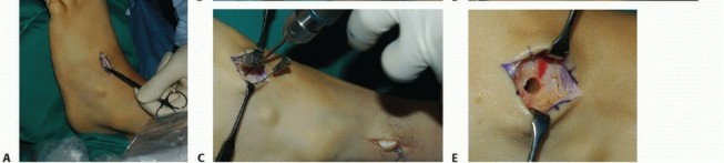 Illustration 14 for Foot Drop Surgery: How a Pin or Drill Elevates Tendon Transfer