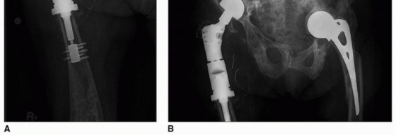 Illustration 44 for Allograft Prosthetic Composite: Mastering Proximal Femur Reconstruction