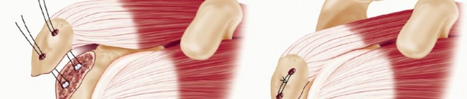 Illustration 11 for Optimizing Fixation of Proximal Humerus Fractures: A Guide