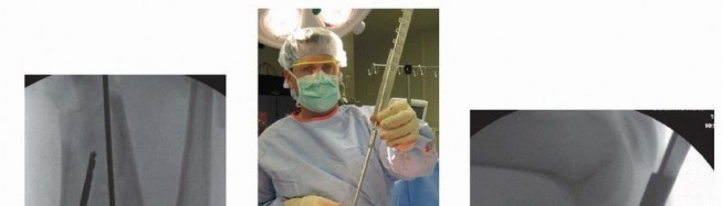 Illustration 34 for Optimizing Intramedullary Nailing for Tibial Shaft Fractures