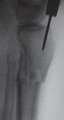 Illustration 31 for Optimal Nailing of the Tibia: Techniques for Challenging Fractures