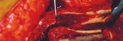 Illustration 18 for Optimizing Outcomes: Two Stage Revision for Infected Total Hip Replacement