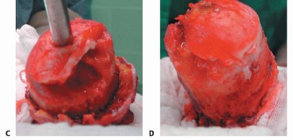 Illustration 13 for Hip Resurfacing: The Bone-Sparing Solution around the Femoral Head