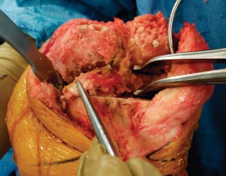 Illustration 28 for Precision Soft Tissue Balancing in Revision: Avoid TKA Pitfalls