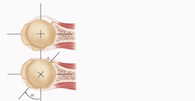 Illustration 27 for Mastering the Treatment of Recurrent Posterior Shoulder Instability