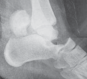 Illustration 4 for Talar Neck Fracture Treatment: Optimizing Recovery with ORIF