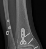 Illustration 11 for Partial Articular Fractureplate Fixation: Restore Anatomy