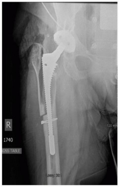 Illustration 8 for Revision THA: Why Extensively Porouscoated Cylindrical Stems Excel