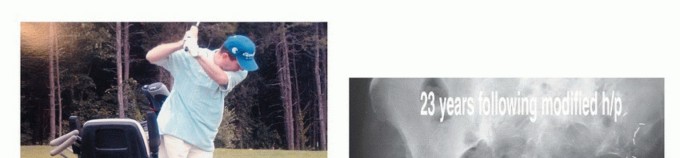 Illustration 28 for Posterior Flap Hemipelvectomy: Mastering Techniques for Optimal Outcomes