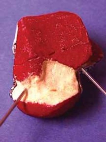 Illustration 23 for Talar Neck Fracture Treatment: Optimizing Recovery with ORIF