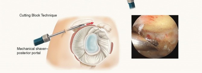 Illustration 12 for Find Relief: Arthroscopic Subacromial Decompression for Impingement