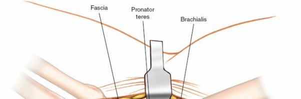 Illustration 44 for Mastering Elbow Approaches: Applied Surgical Anatomy for Precision