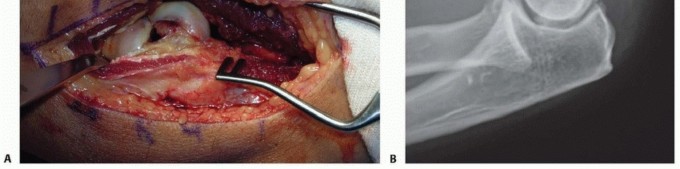 Illustration 7 for Navigating Capitellum and Capitellar-Trochlear Shear Fracture Repair