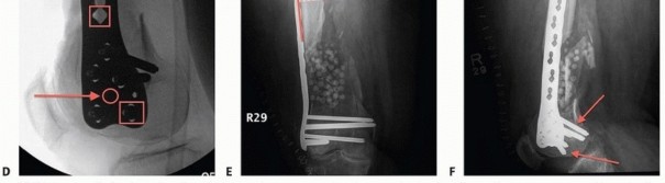 Illustration 27 for Repairing Distal Femur Fractures: Open Reduction & Internal Fixation