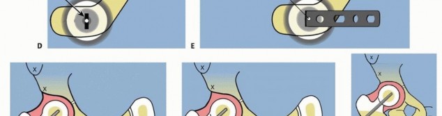 Illustration 24 for Treatment for Congenital Femoral Deficiency: What You Need to Know