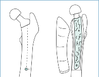 Mastering Short External Rotators for Optimal Hip Surgery Results