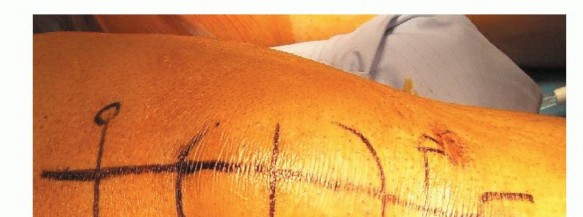 Regain Function: Repairing Acute & Chronic Quadriceps Tendon Ruptures