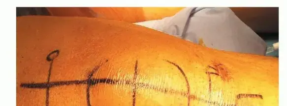 صورة توضيحية لـ تمزق وتر العضلة الرباعية: دليل شامل للمرضى نحو الشفاء الكامل على يد الأستاذ الدكتور محمد هطيف