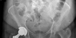 Illustration 3 for Achieving Success with Uncemented Hip Arthroplasty Metal Socket