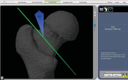 Illustration 22 for Robotics in Total Hip Arthroplasty: A New Era of Precision