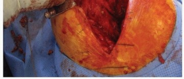 Illustration 20 for Extended Trochanteric Osteotomy: How et al Extended Revision THA Solutions