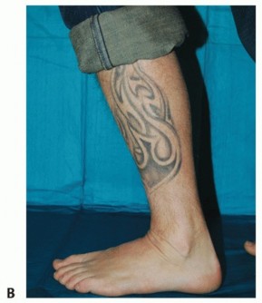 Illustration 48 for Unlock Healing: Medial Malleolar Osteotomy for Talus OLT Allografts