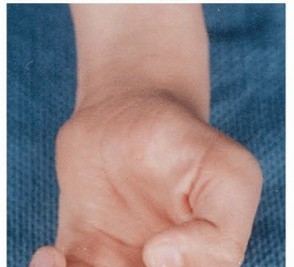 Tendon Transfers for Median Nerve Palsy