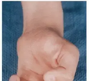 صورة توضيحية لـ شلل العصب الأوسط ونقل الأوتار: دليل شامل للمرضى لاستعادة وظيفة اليد