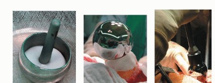 Illustration 17 for Hip Resurfacing: The Bone-Sparing Solution around the Femoral Head