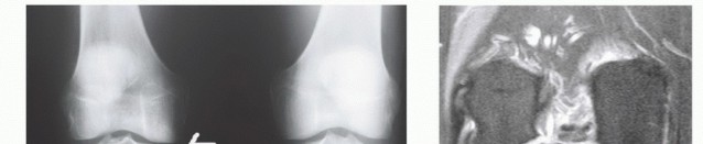 Illustration 3 for Symptomatic Knee? Meniscal Transplant for Anterior & Posterior Horns