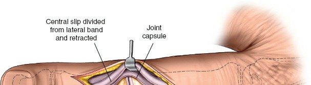 Illustration 5 for Unlock Easier Access: Dorsal Approach for Phalanges and Interphalangeal Joints