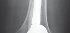 Illustration 21 for Solving Severe Bone Loss: Tantalum for Patellar Reconstruction
