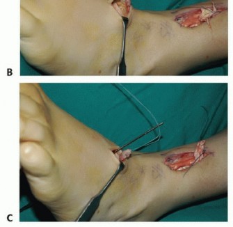 Illustration 52 for Foot Drop Surgery: How a Pin or Drill Elevates Tendon Transfer