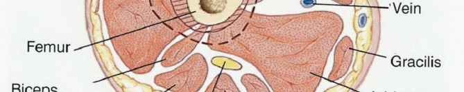 Illustration 3 for Advanced Distal Femoral Resections: Limb-Sparing Outcomes & Techniques