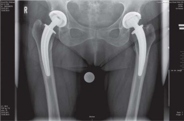 Illustration 81 for Collum Femoris Preserving: Achieve Better Primary Hip Outcomes