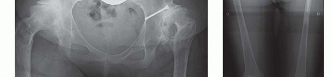 Illustration 15 for Special THA Techniques for Severe Deformities Around the Hip