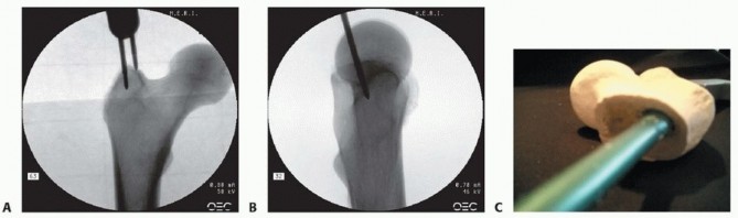 Illustration 19 for Achieve Optimal Femoral Head Fixation with Cephalomedullary Nailing