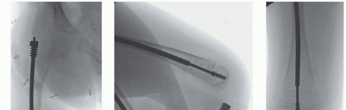 Illustration 22 for Less Pain, More Function: Fassier-Duval Nailing for Osteogenesis Imperfecta