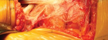 Illustration 58 for Successful Total Hip Replacement in Developmental Dysplasia