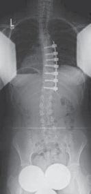 Illustration 7 for Mastering Anterior Interbody Arthrodesis with Instrumentation for Scoliosis